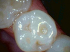 Acid erosion of cusp of premolar