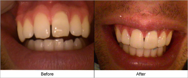 Cosmetic Bonding Tooth Repair