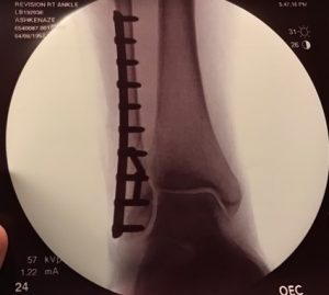 Debi Bell's post-op X-ray