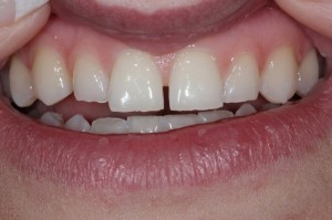 dental gaps in front teeth