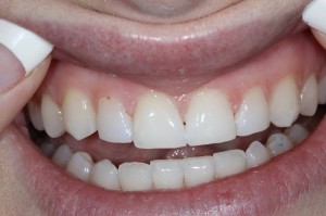 four front teeth bonded to close gaps