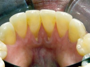 Constant wear on the gingiva causes recession