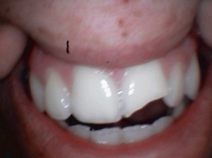 FRACTURED CENTRAL INCISOR