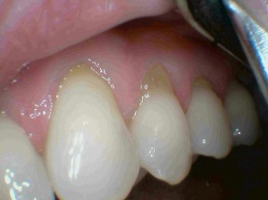 Gum Recession and root surface abrasion