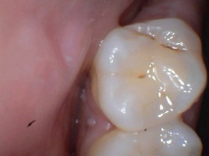 should stains in a tooth be filled