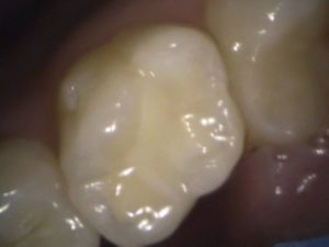 Tooth restored with porcelain filling