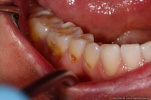 teeth melted by stomach acid