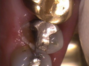 Broken tooth around silver filling