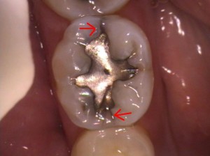 Lower first molar with a filling and crazelines