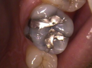 Visible fracture lines in a possibly cracked tooth