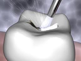 air abrasion handpiece taking out decay