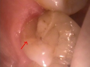 Tooth with porcelin filling and fracture