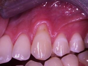 Toothbrush abrasion and gum recession #6